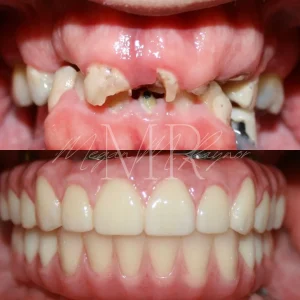 teeth-before-after